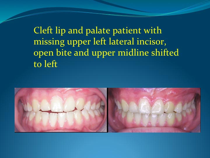 Cleft Lip and Palate Patient in London Ontario