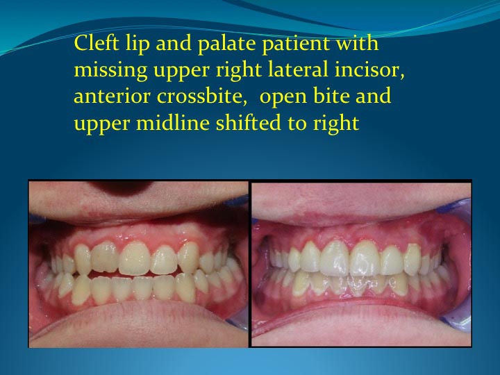 Cleft Lip and Palate Treatment in London Ontario - Wonder West Orthodontics