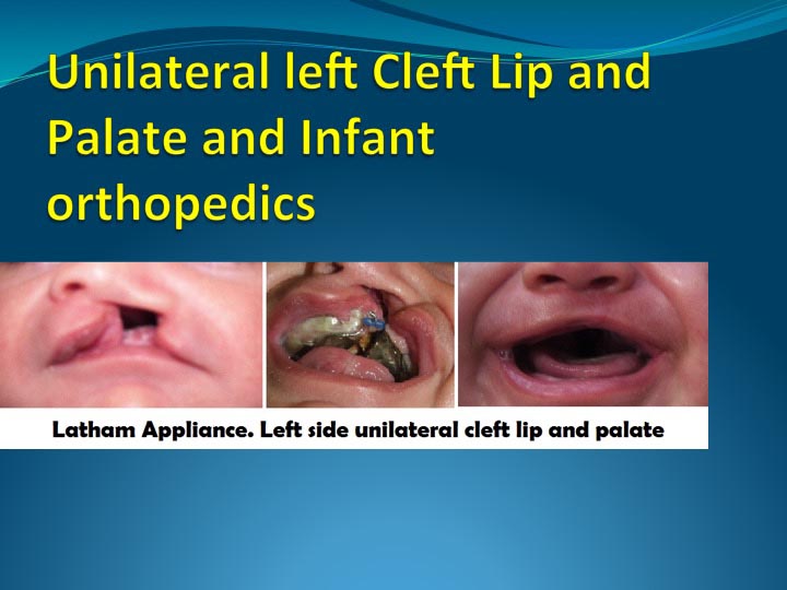 Left side unilateral cleft lip treatment in London Ontario