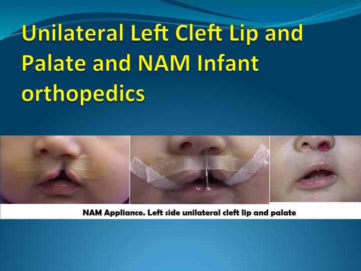 NAM Appliance for Cleft Lip Treatment in London Ontario