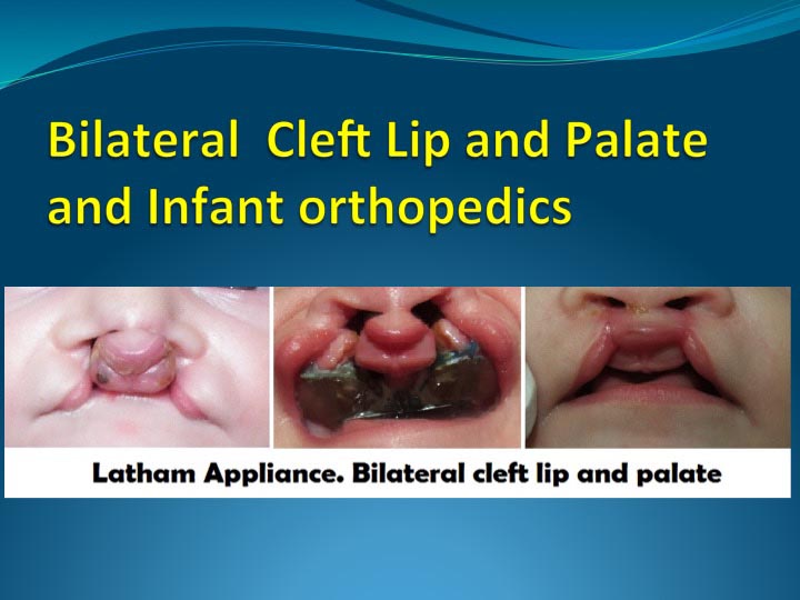 Unilateral Left Cleft Lip & Palate & Infant Orthopedics - Wonder West Orthodontics in London, ON