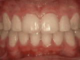 Crowding of teeth after braces - Wonder West Orthodontics in London Ontario