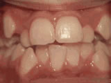 Crowding of teeth before braces - Wonder West Orthodontics in London Ontario