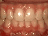 Deep overbite after braces and corrective jaw surgery - Wonder West Orthodontics in London Ontario