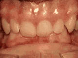 Deep overbite before braces and corrective jaw surgery - Wonder West Orthodontics in London Ontario