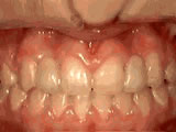 Missing lateral incisors due to congenital reasons before braces treatment in London Ontario