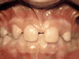 Missing lateral incisors due to congenital reasons before braces treatment - Wonder West Orthodontics in London Ontario