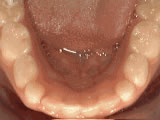 Crowding of lower permanent teeth after orthodontic treatment - Wonder West Orthodontics in London Ontario