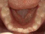 Crowding of lower permanent teeth before orthodontic treatment - Wonder West Orthodontics in London Ontario