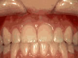 Open bite after orthodontic treatment - Wonder West Orthodontics in London Ontario