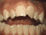 Open bite before orthodontic treatment - Wonder West Orthodontics in London Ontario