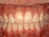 Protruding front teeth or overjet corrected by orthodontic treatment - Wonder West Orthodontics in London Ontario
