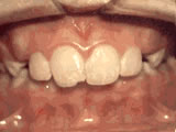 Overjet before professional orthodontic treatment - Wonder West Orthodontics in London Ontario