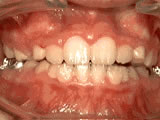 Crowded teeth after phase-one orthodontic treatment - Wonder West Orthodontics in London Ontario