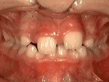 Crowded teeth before phase-one orthodontic treatment - Wonder West Orthodontics in London Ontario