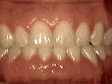 Teeth Spacing corrected by orthodontic treatment - Wonder West Orthodontics in London Ontario