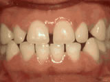 Teeth spacing before permanent retainers - Wonder West Orthodontics in London Ontario