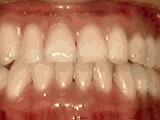 Underbite after orthodontic treatment - Wonder West Orthodontics in London Ontario