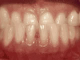 Underbite before orthodontic treatment - Wonder West Orthodontics in London Ontario