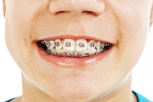 How to Determine If You Need Braces
