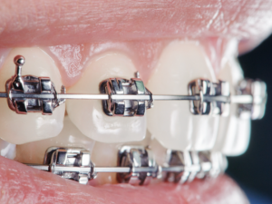 Reasons Why Braces Brackets Fall Off and What You Can Do