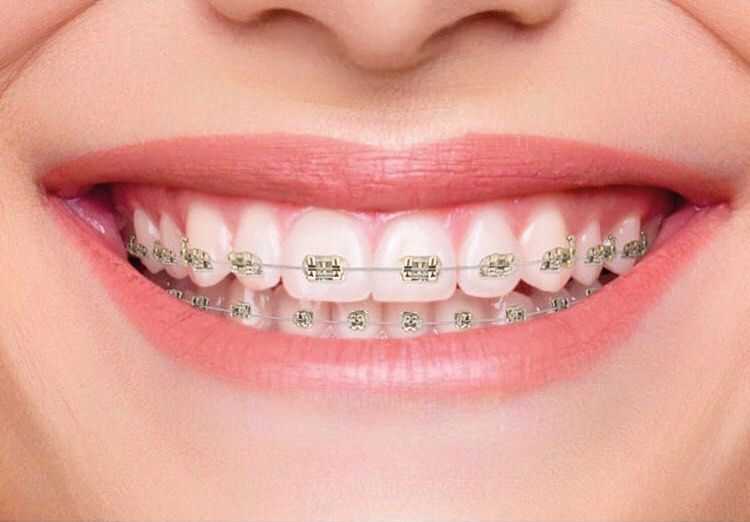 Iconix® Aesthetic Champagne Gold Braces at Wonder West Orthodontics
