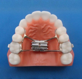 Palate expander treatment at Wonder West Orthodontics