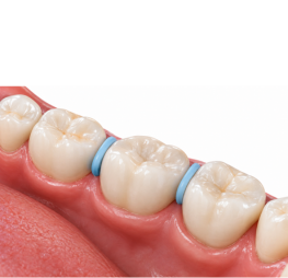 Orthodontic spacer placed between molars before braces treatment at Wonder West Orthodontics