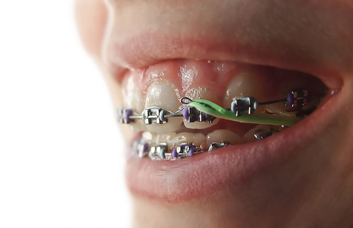 Do I really need to wear my rubber bands with my braces?