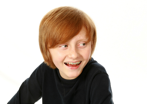 What is a palatal expander?